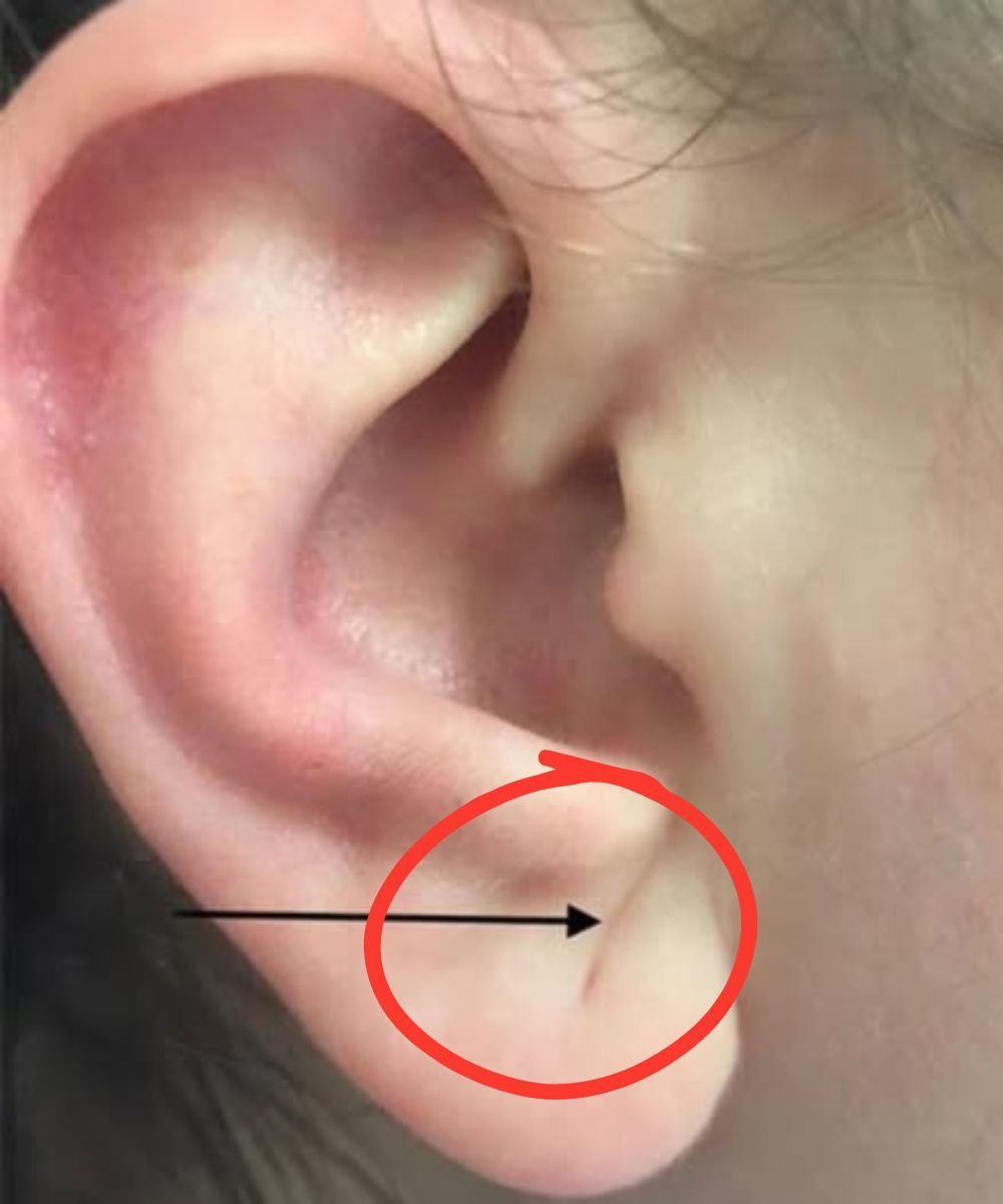 Εάν αυτό το σημάδι εμφανιστεί στο αυτί σας, είναι ένα προειδοποιητικό σημάδι ότι έχετε...