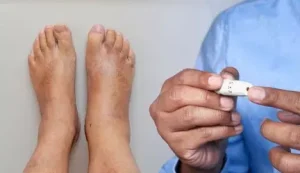 Τα συμπτώματα του διαβήτη περιλαμβάνουν ασυνήθιστα σημάδια στα πόδια – πώς να τα εντοπίσετε