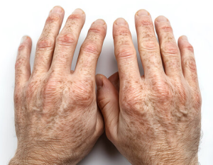 Κηλίδες στα Χέρια: Είναι Σημάδια Μελανώματος – της πιο Επικίνδυνης Μορφής Καρκίνου του Δέρματος;