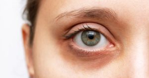 Οι σκούροι κύκλοι κάτω από τα μάτια μπορεί να προειδοποιούν για θέματα υγείας