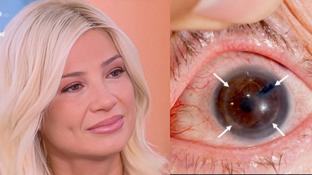 Φαίη Σκορδά: Τι είναι ο κερατόκωνος με τον οποίο έχει διαγνωσθεί – Συμπτώματα, αιτίες και διάγνωση