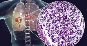 Ο αόρατος Kivδuvoς – Τι κοινό υλικό κουζίνας συνδέεται με Kαpκivo πνεύμονα – Πpoσoxn στο σπίτι σας