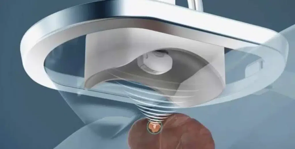 Δημιουργήθηκε ρομπότ που καταστρέφει καρκινώματα με υπέρηχο