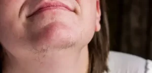 Αν είστε γυναίκα με γένια στο σαγόνι να τι σημαίνει για εσάς – Αυτές οι τρίχες στο…