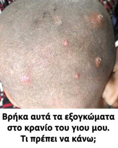 Βρήκα αυτά τα εξογκώματα στο τριχωτό της κεφαλής του γιου μου