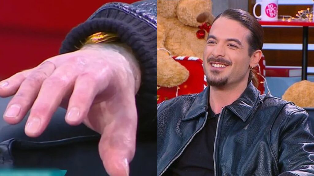 «Το χαϊδέψανε και μου είπανε “μπαμπά, το μιμί πέρασε”»: Ο Άρης Μουγκοπέτρος δείχνει για πρώτη φορά τα πρόσθετα δάχτυλά του