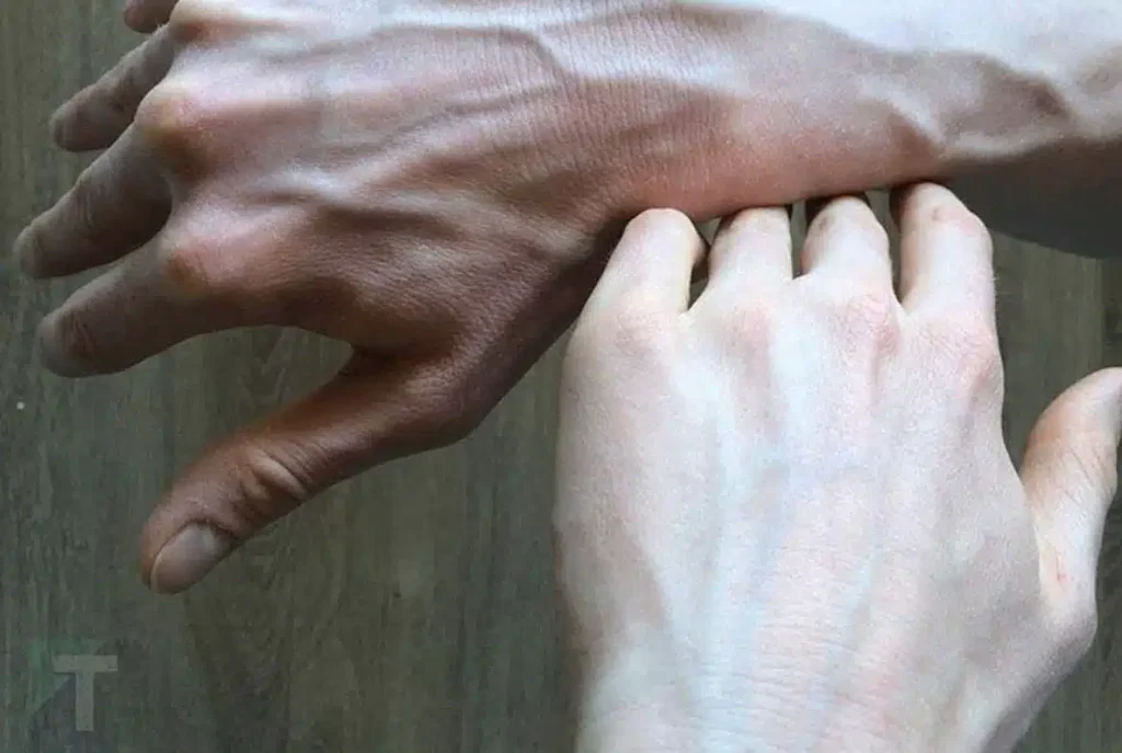 Αν δείτε κάποιον με διογκωμένες φλέβες, πρέπει να του πείτε αυτά τα πράγματα