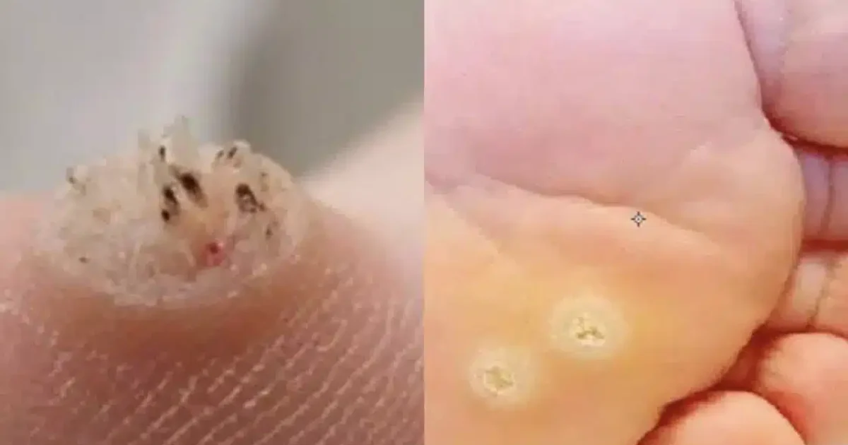 Προειδοποιητικό σημάδι: Αυτός ο τύπος δερματικής ανάπτυξης ίσως υποδηλώνει κάτι σοβαρό