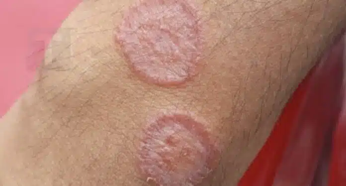 Απλές συμβουλές για να αποφύγετε την μυκητίαση του δέρματος