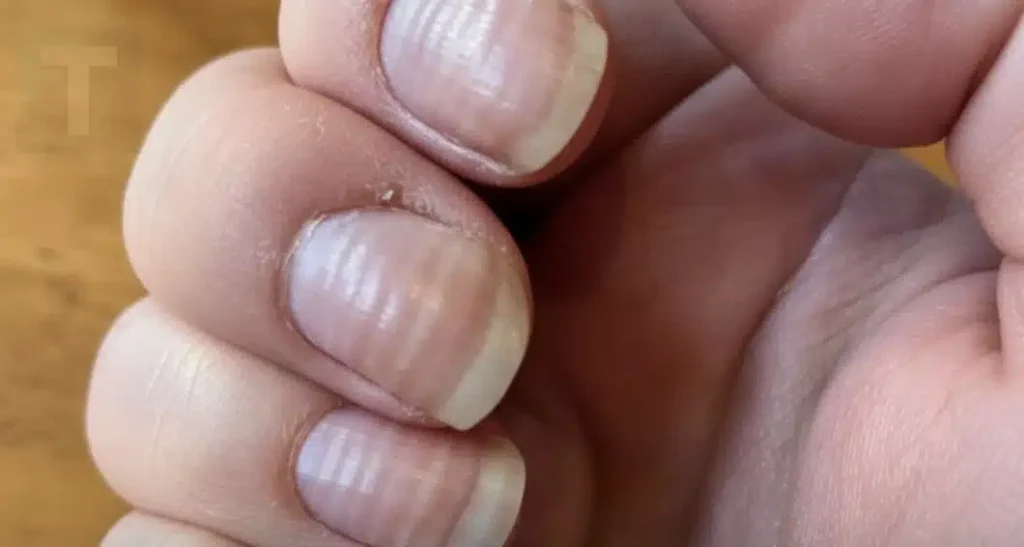 Τι πραγματικά αποκαλύπτουν οι ραβδώσεις στα νύχια σας για την υγεία σας