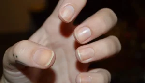 Αν δείτε αυτό το σημάδι στα νύχια σας, πάρτε άμεσα τον γιατρό σας – «Δείχνει» ύπουλη και θανατηφόρα καρδιακή νόσο
