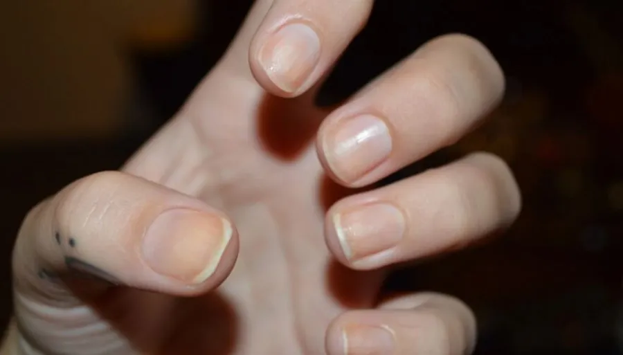 Αν δείτε αυτό το σημάδι στα νύχια σας, πάρτε άμεσα τον γιατρό σας - «Δείχνει» ύπουλη και θανατηφόρα καρδιακή νόσο