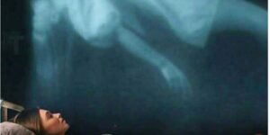 Οι ειδικοί ρίχνουν φως στο φαινόμενο του «επιθανάτιου ρόγχου» πριν τον θάνατο