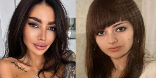 Τι μεταμόρφωση! Δείτε πώς ήταν η γνωστή Ουκρανή μοντέλο πριν την πλαστική χειρουργική επέμβαση.