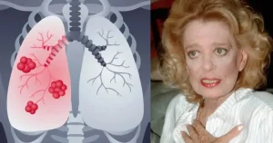 Καρκίνος του πνεύμονα: Τα ύπουλα συμπτώματα που… σκότωσαν την Μελίνα Μερκούρη – Τροφές που μπορούν να τον προκαλέσουν