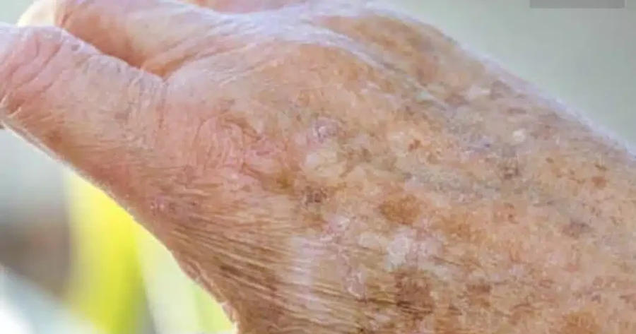 Γνωρίζατε ότι αν εμφανιστούν κηλίδες στα χέρια σας, είναι ξεκάθαρο σημάδι ότι…