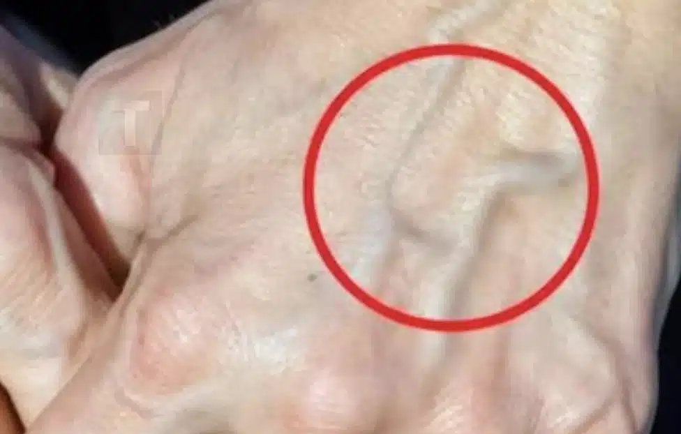 Πότε να ανησυχείτε για τις φλέβες που εμφανίζονται ξαφνικά