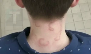 Ο 8χρονος γιος μου το έχει αυτό εδώ και 2 μήνες συνεχόμενα χειροτέρεψε από την πρώτη φορά που το είχε αυτό