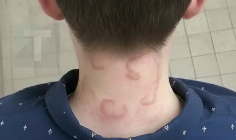 Ο 8χρονος γιος μου το έχει αυτό εδώ και 2 μήνες συνεχόμενα χειροτέρεψε από την πρώτη φορά που το είχε αυτό