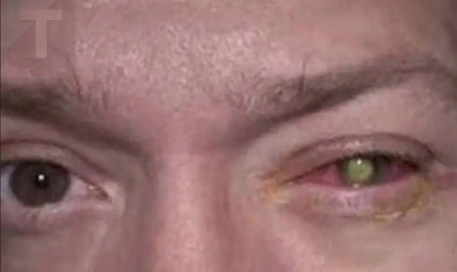 Έχασε την όρασή του εξαιτίας ενός νυχτερινού λάθους