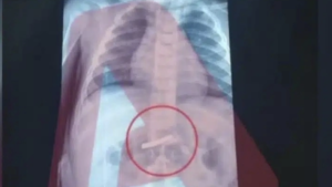 ΣΤΟ ΝΟΣΟΚΟΜΕΙΟ ΠΑΙΔΩΝ 3ΧΡΟΝΟ ΑΓΟΡΑΚΙ: ΔΥΣΤΥΧΩΣ ΚΑΤΑΠΙΕ…